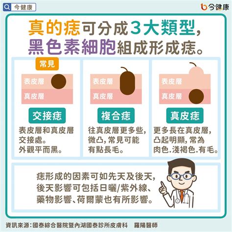 為什麼身上會有痣|是痣？還是皮膚癌？皮膚科醫師教你揪出「假的痣」，。